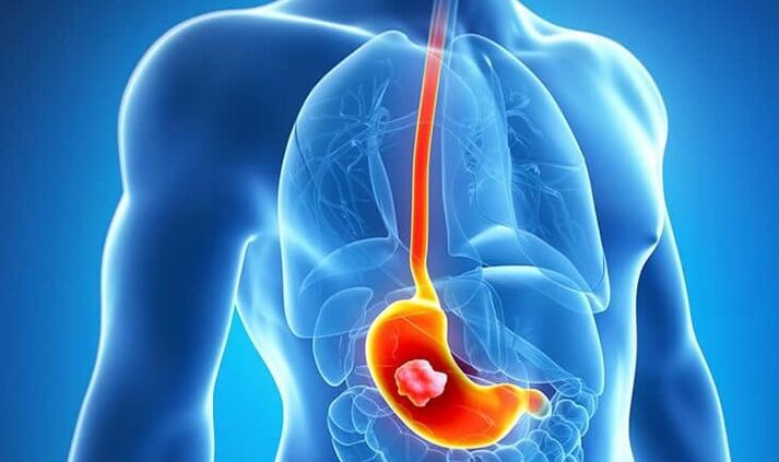 If you suffer from stomach ulcers, following the Dukan diet is contraindicated.